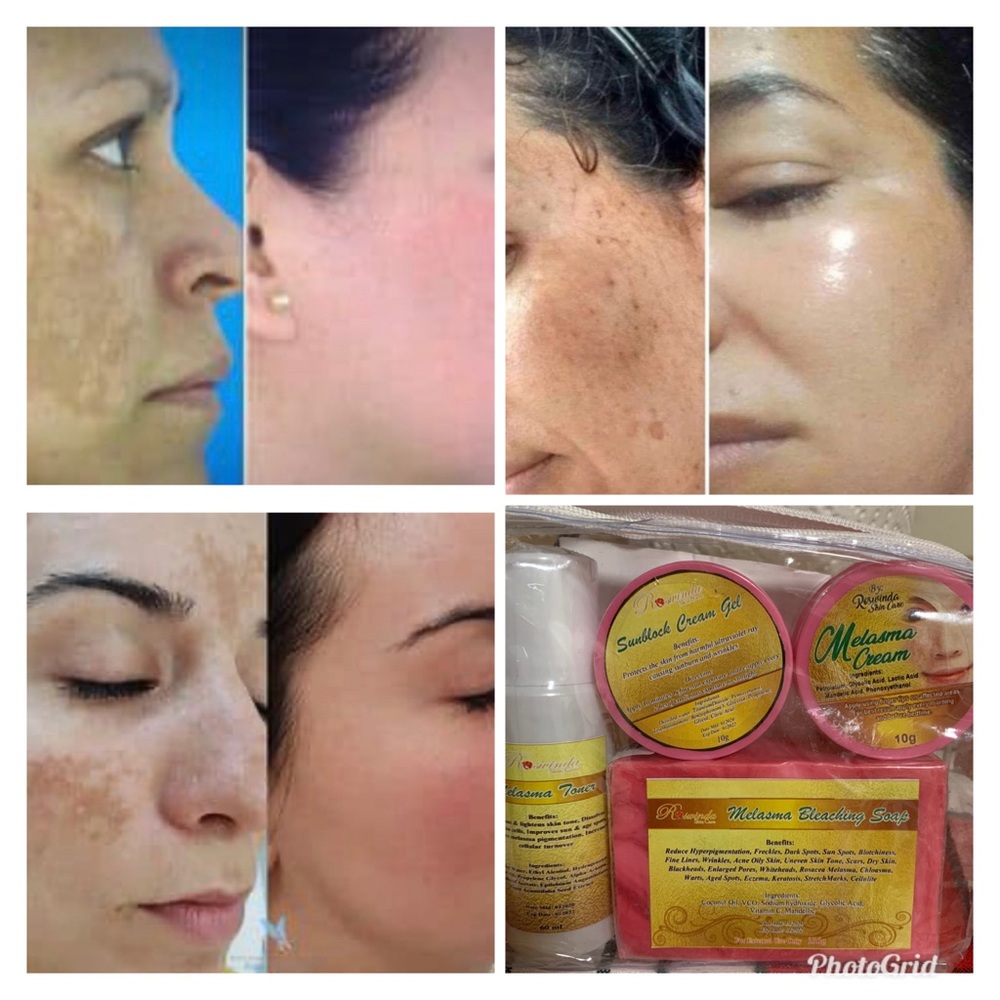 Roswinda Skin Care Melasma Set Best Seller